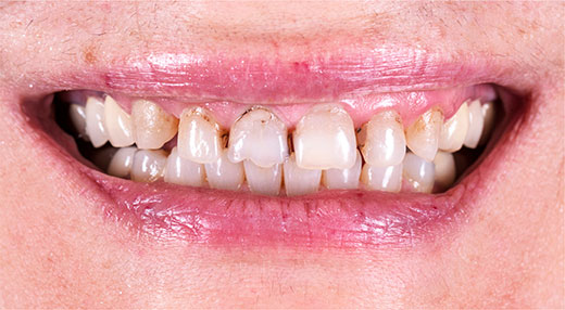 Dentures Crawley |  Teeth Replacement and Repairs in Crawley - before