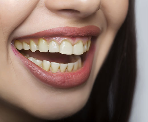 Teeth Whitening Crawley | Tooth Whitening Services Crawley - before