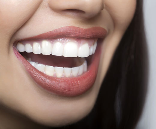 Teeth Whitening Crawley | Tooth Whitening Services Crawley - after