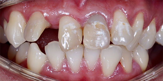 Dental Fillings Crawley | Composite Fillings - before