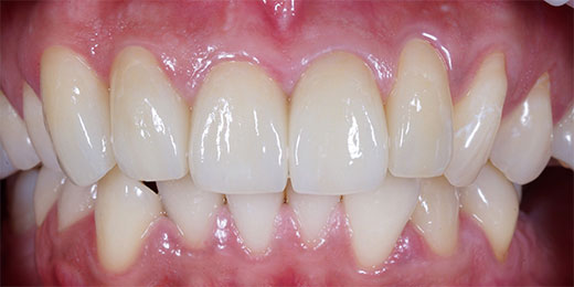 Dental Fillings Crawley | Composite Fillings - after