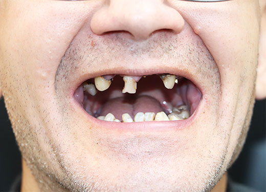 Dental Implants Crawley | Implant Dentist in Crawley - before