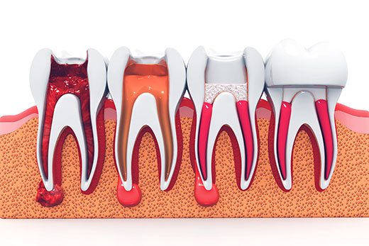 Root Canal Treatment Crawley | RCT
